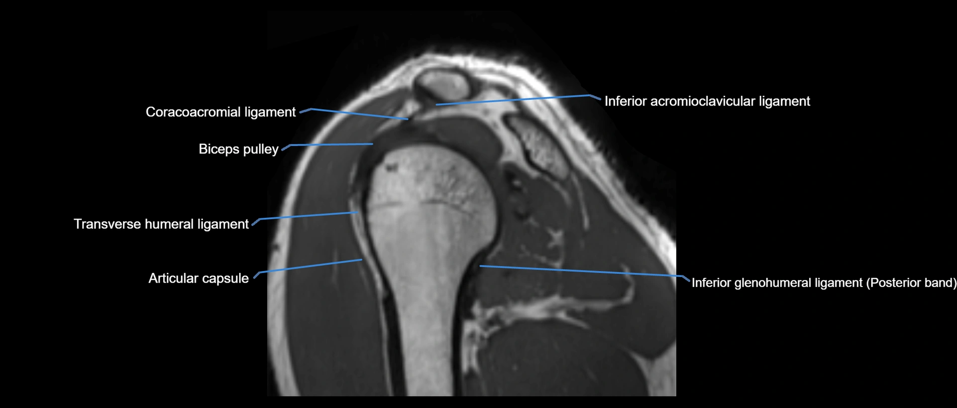 shoulder ligaments sagittal  cross sectional anatomy 3T MRI AI enhanced radiology image -img-00001-00039.webp